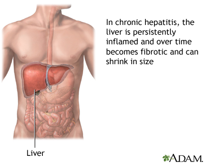 Chronic hepatitis Chronic hepatitis
