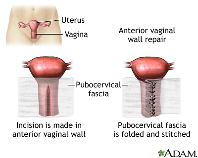 Anterior vaginal wall repair Anterior vaginal wall repair