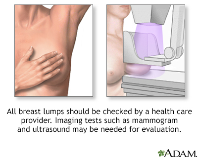 Breast lumps Breast lumps
