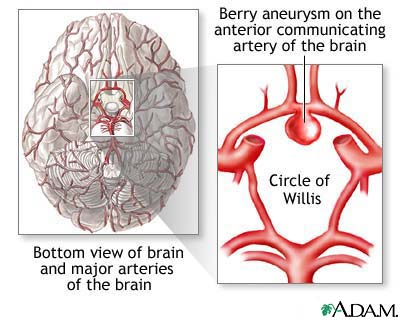 Cerebral aneurysm Cerebral aneurysm