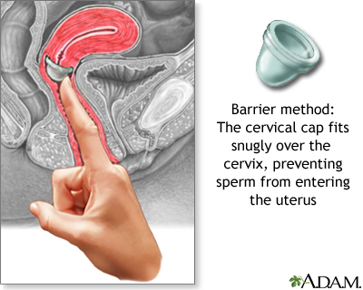 The cervical cap