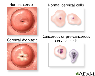Cervical neoplasia Cervical neoplasia
