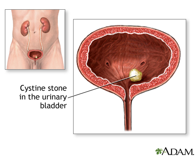 Cystinuria Cystinuria