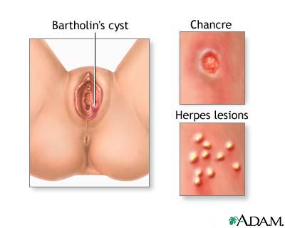 Genital sores (female) Genital sores (female)
