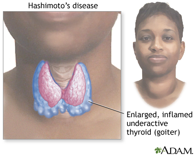 Hashimoto's disease (chronic thyroiditis) Hashimoto's disease (chronic thyroiditis)