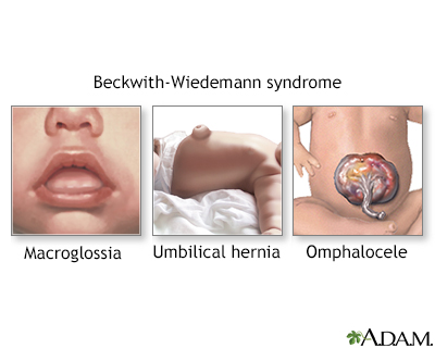Beckwith-Wiedemann syndrome Beckwith-Wiedemann syndrome
