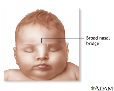 Broad nasal bridge Broad nasal bridge