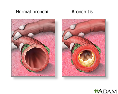 Bronchitis Bronchitis