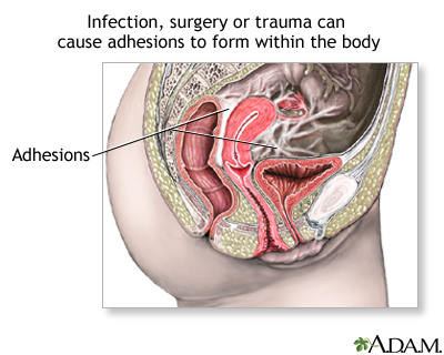 Pelvic adhesions Pelvic adhesions