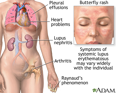 Systemic lupus erythematosus Systemic lupus erythematosus