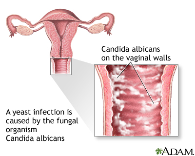 Yeast infections Yeast infections