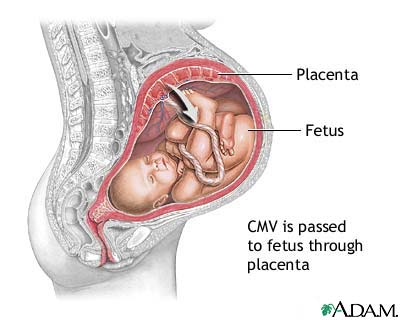 Congenital cytomegalovirus Congenital cytomegalovirus