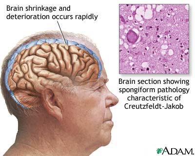 Creutzfeldt-Jakob disease Creutzfeldt-Jakob disease