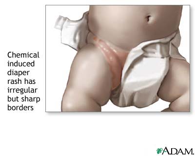 Diaper rash Diaper rash