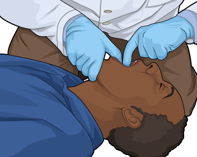 First Aid for Choking - unconscious adult or child over 1 year First Aid for Choking - unconscious adult or child over 1 year