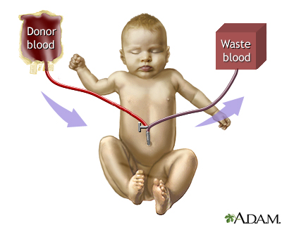 Exchange transfusion - Procedure Exchange transfusion - Procedure