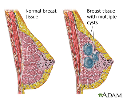 Fibrocystic breast change Fibrocystic breast change