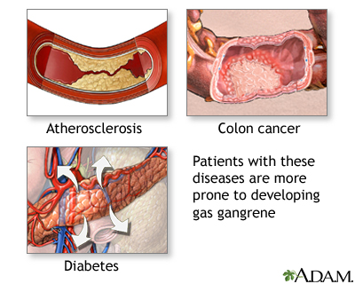 Gas gangrene Gas gangrene