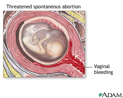 Threatened miscarriage Threatened miscarriage