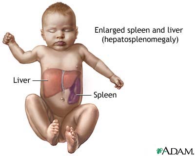 Hepatosplenomegaly Hepatosplenomegaly