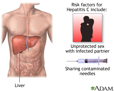 Hepatitis C Hepatitis C