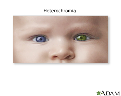 Heterochromia Heterochromia