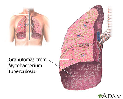Miliary tuberculosis Miliary tuberculosis