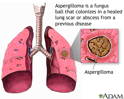 Aspergilloma Aspergilloma