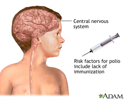 Poliomyelitis Poliomyelitis