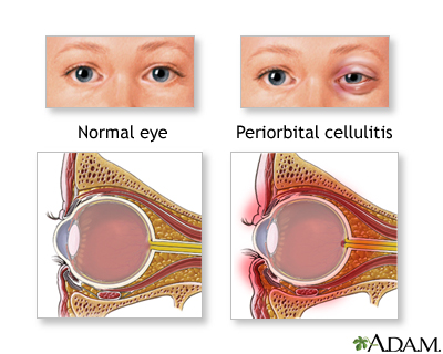 Periorbital cellulitis Periorbital cellulitis
