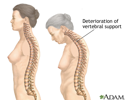 Osteoporosis Osteoporosis