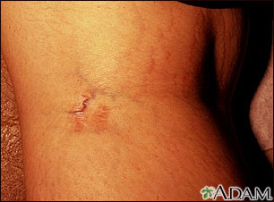 Striae in the popliteal fossa Striae in the popliteal fossa