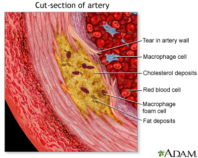 Enlarged view of atherosclerosis Enlarged view of atherosclerosis