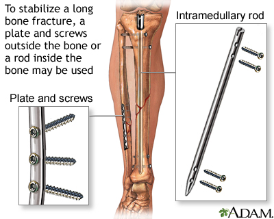 Internal fixation devices Internal fixation devices