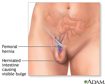 Femoral hernia Femoral hernia