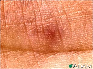 Janeway lesion - close-up Janeway lesion - close-up