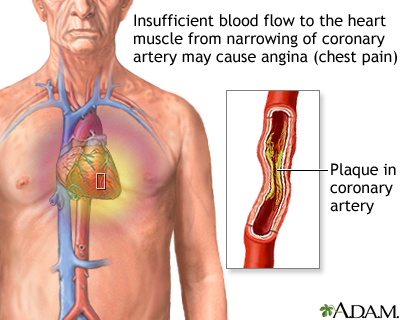 Stable angina Stable angina