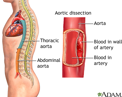 Aortic dissection Aortic dissection