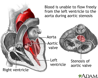 Aortic stenosis Aortic stenosis