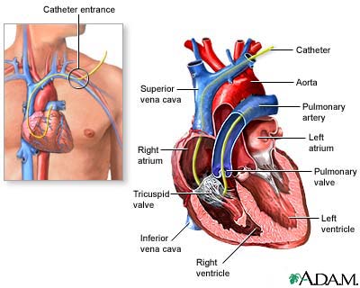 Swan Ganz catheterization Swan Ganz catheterization
