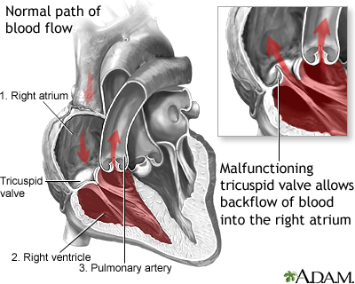 Tricuspid Regurgitation Tricuspid Regurgitation