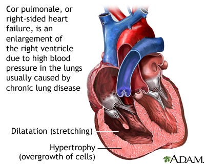Cor pulmonale Cor pulmonale