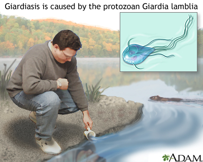 Giardiasis Giardiasis