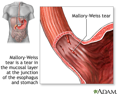 Mallory-Weiss tear Mallory-Weiss tear