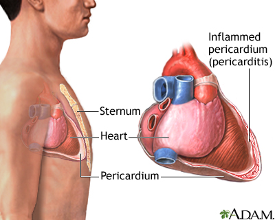 Pericarditis Pericarditis