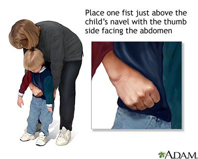 Heimlich maneuver on conscious child Heimlich maneuver on conscious child