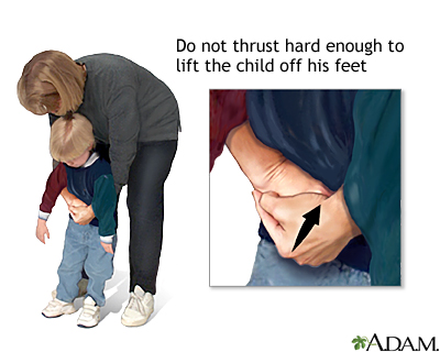 Heimlich maneuver on conscious child Heimlich maneuver on conscious child