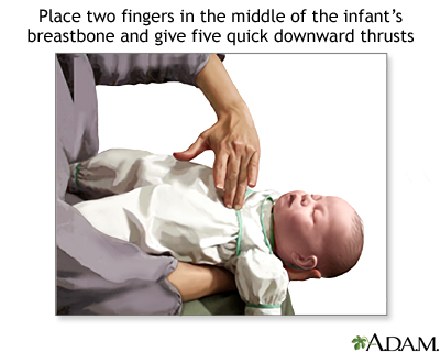 Heimlich maneuver on infant Heimlich maneuver on infant