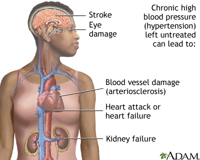 Untreated hypertension Untreated hypertension