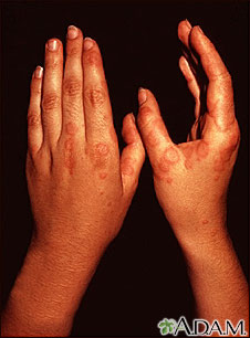 Erythema multiforme, circular lesions - hands Erythema multiforme, circular lesions - hands